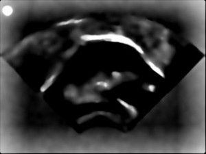 ultrasound image LoG_2
